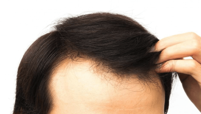 안전하고 저렴한 탈모 솔루션을 제공하는 한국 사이트